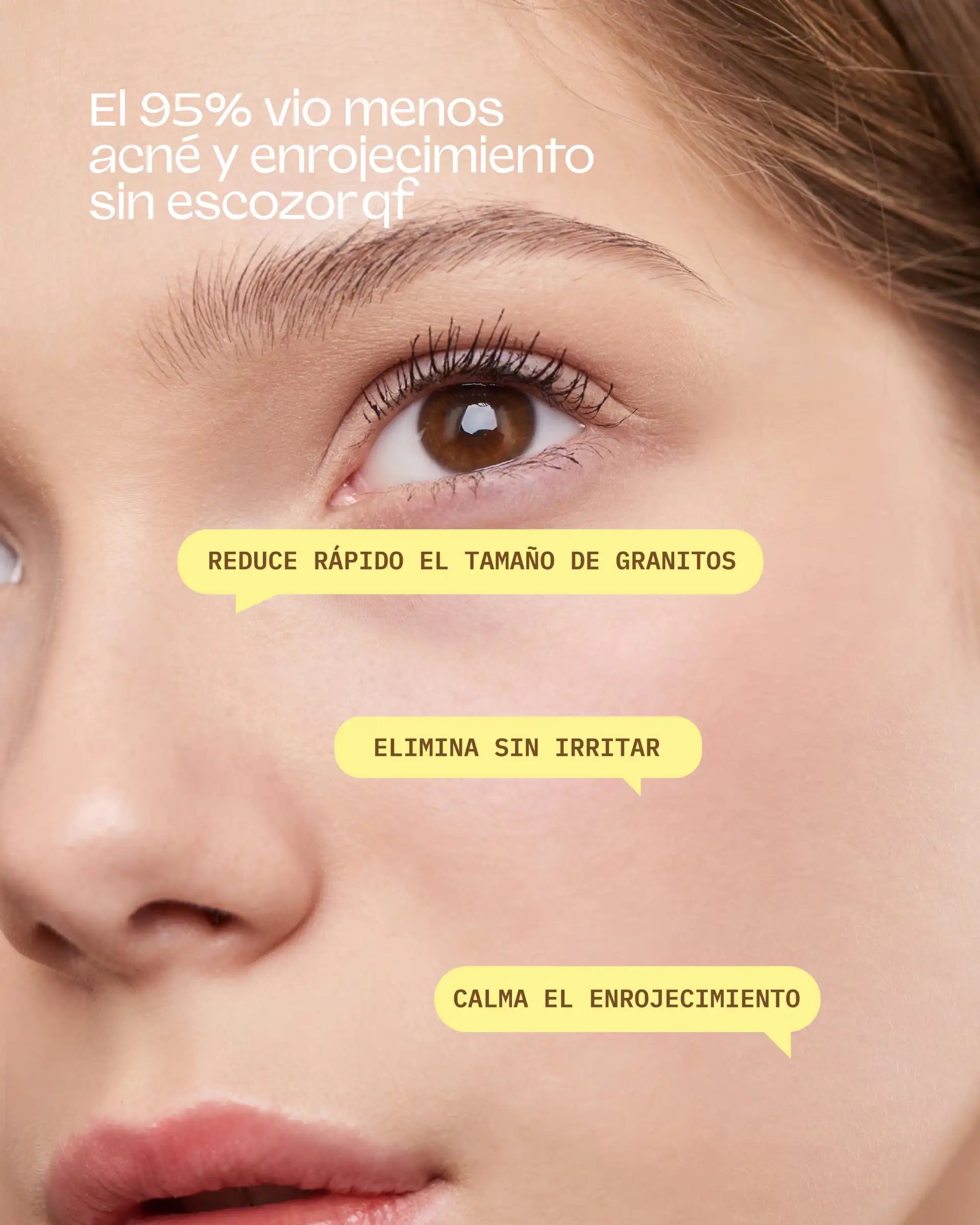 Bye Breakouts Cream (HS)